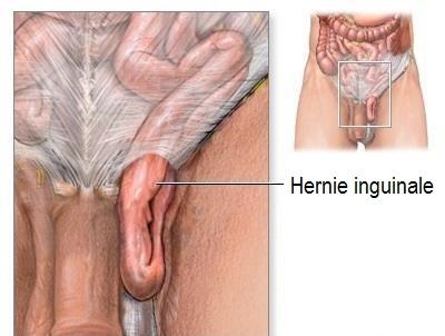 Comment savoir si j'ai une hernie inguinale - Étape 1