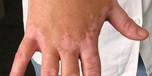 Comment soigner le vitiligo naturellement