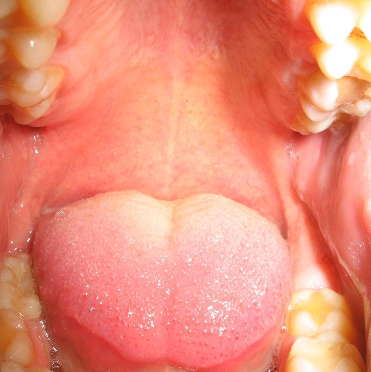 Comment traiter les polypes de gorge