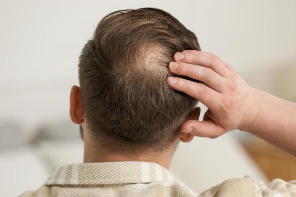 Finastéride : effets secondaires, syndrome et dangers - Qu'est-ce que le finastéride et à quoi sert-il ?