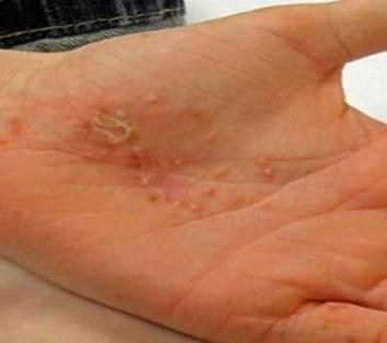 Comment traiter la dyshidrose