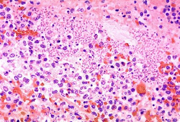 Mauvaise odeur vaginale : mes pertes sentent l'oignon - Mauvaise odeur vaginale : vaginose bactérienne