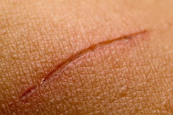 Comment faire disparaître les cicatrices - Étape 6