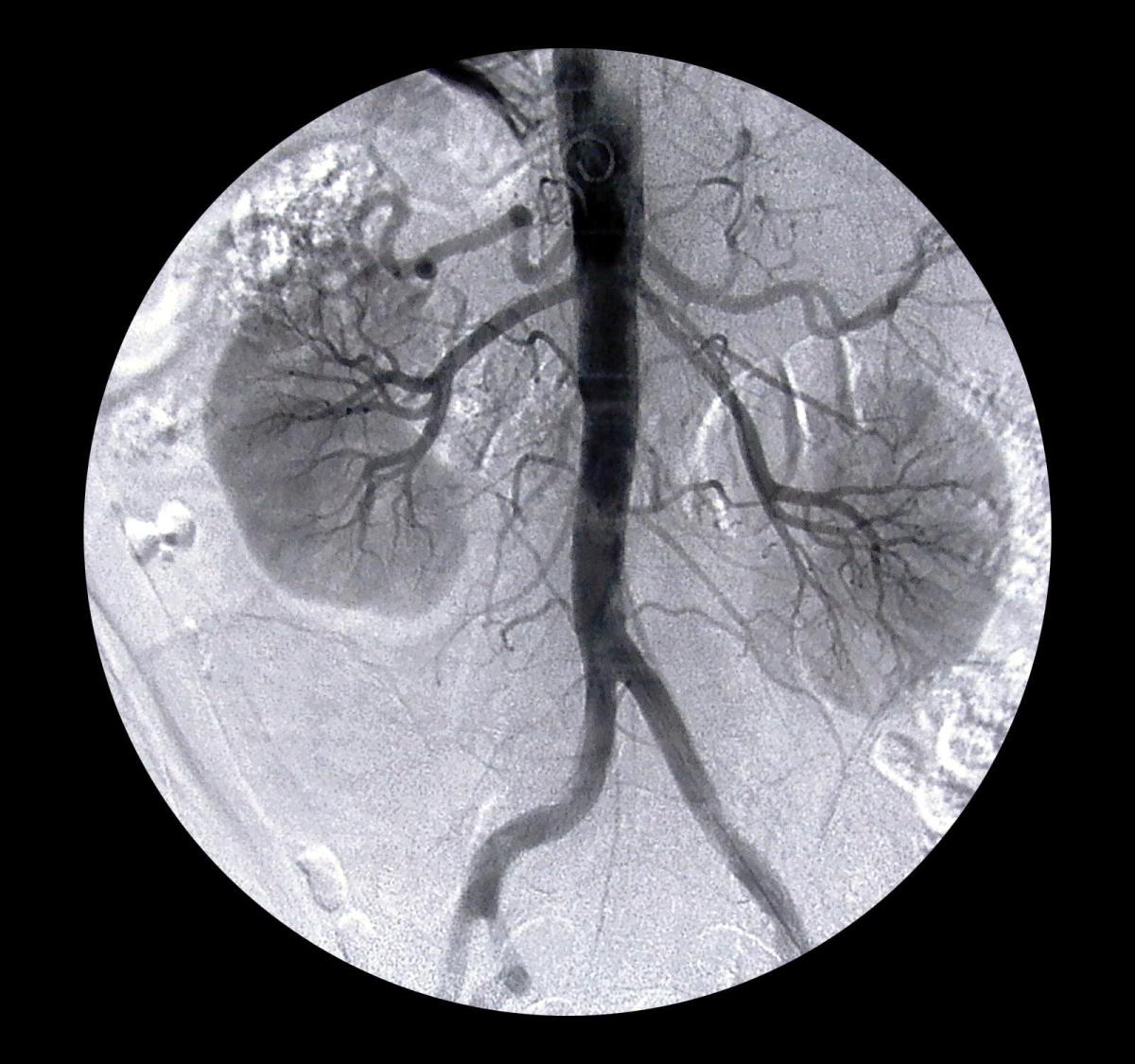 Comment faire baisser ou remonter le taux de créatinine