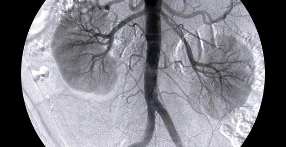 Comment faire baisser ou remonter le taux de créatinine