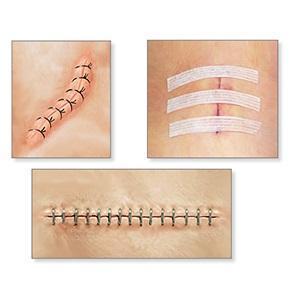 Que faire si je m'ouvre un point de suture