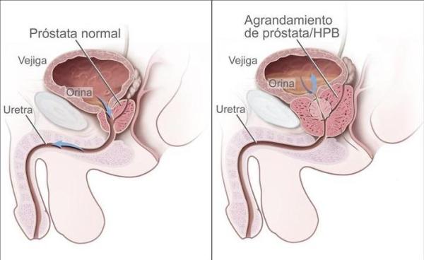 Remèdes maison pour la prostate enflammée