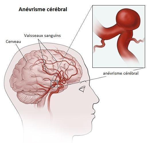 Quelles sont les causes de l'anévrisme cérébral