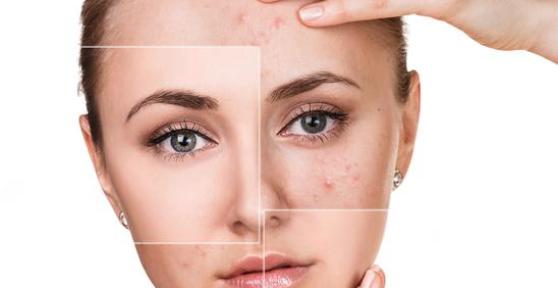 Comment traiter l'acné hormonale naturellement