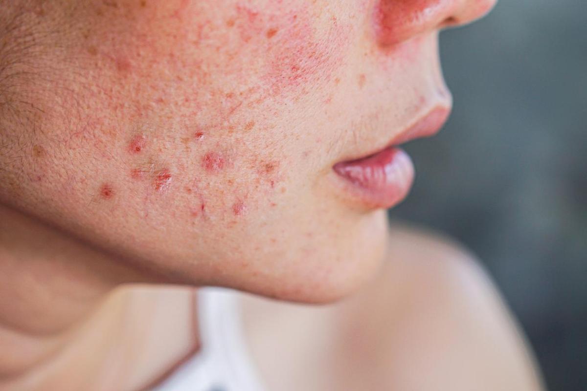 Comment soigner les points noirs infectés
