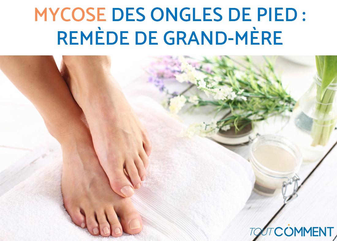 Mycose des ongles de pied : remède de grand mère - TOP 14