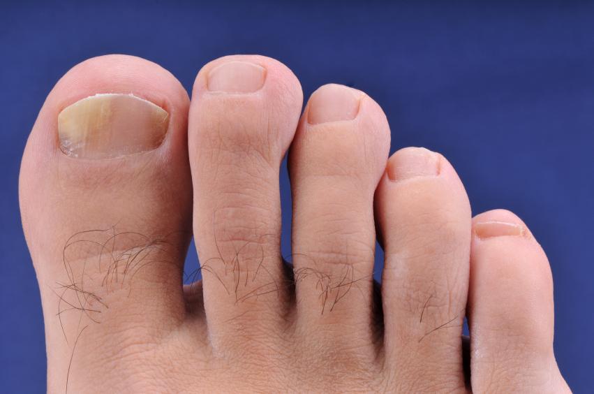 Mycose des ongles de pied : remède de grand mère - TOP 14