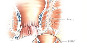 Comment soigner une fissure anale sans chirurgie