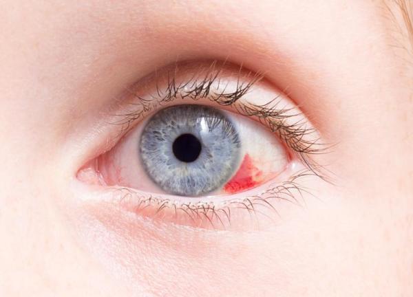 Pourquoi j'ai une tache de sang dans l'oeil