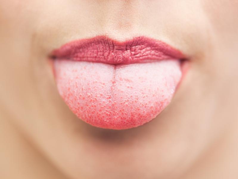 Comment soulager une brûlure sur la langue 6 étapes
