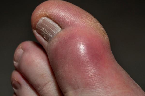 Engelures aux pieds : cause, remède et traitement - Qu'est-ce que les engelure aux pieds ?