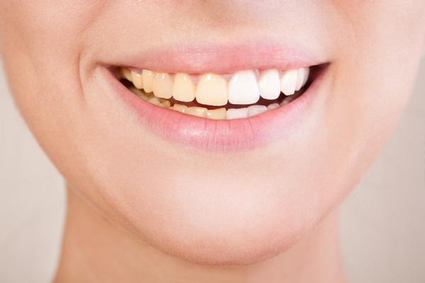 Pourquoi mes dents sont jaunes