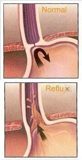 Pourquoi j'ai des aigreurs d'estomac - Pourquoi j'ai des d'aigreurs d'estomac : reflux gastro-oesophagien