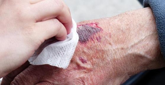 Pourquoi est-ce qu'une blessure sent mauvais