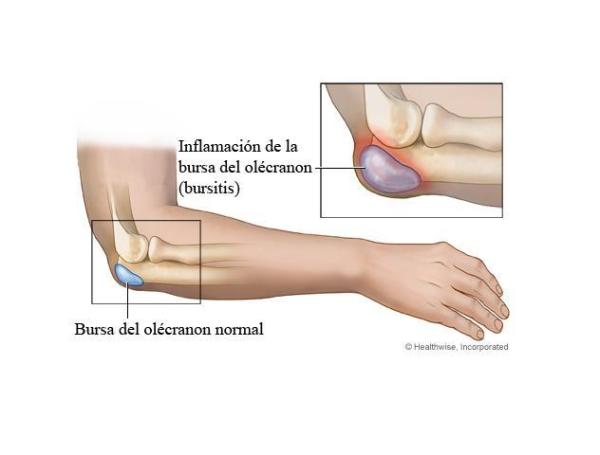 Comment traiter la bursite du coude