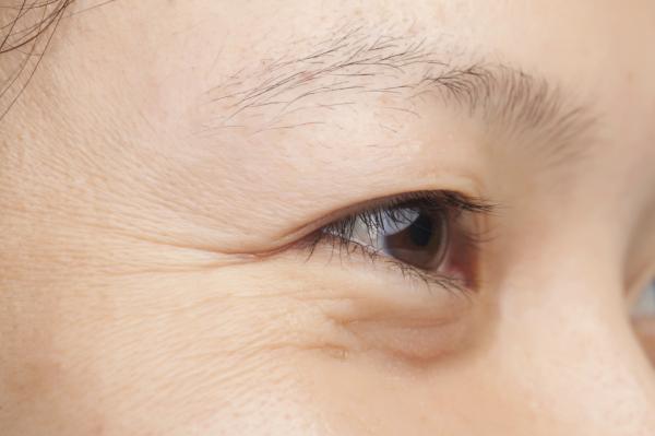Pourquoi j'ai un oeil plus petit que l'autre