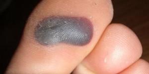 Comment traiter une ampoule remplie de sang 