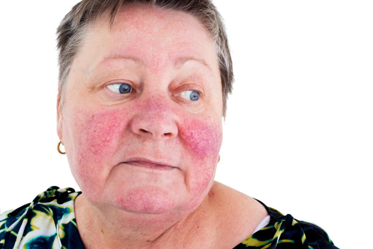 Comment réduire l'inflammation du visage