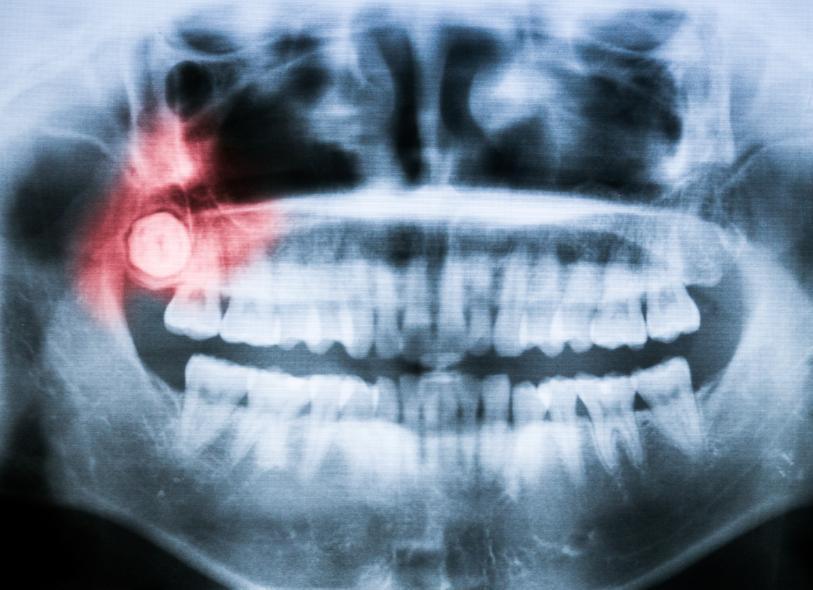 Comment soigner une péricoronarite 6 étapes