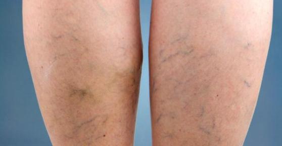 Comment soigner les varices