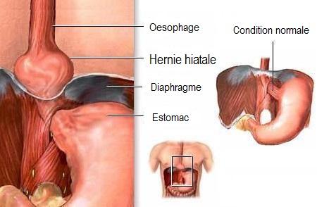 Comment prévenir la hernie hiatale - Étape 1