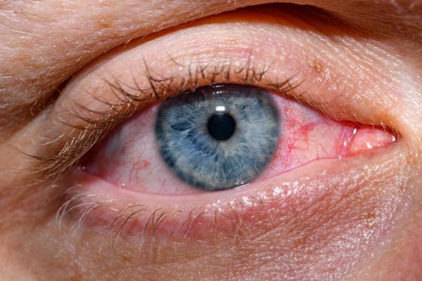 Peut-on dormir les yeux ouverts ? - Symptômes et problèmes de dormir avec les yeux ouverts